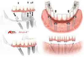 All-On-4 Implant